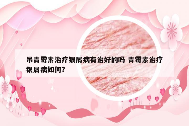 吊青霉素治疗银屑病有治好的吗 青霉素治疗银屑病如何?