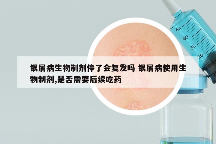 银屑病生物制剂停了会复发吗 银屑病使用生物制剂,是否需要后续吃药