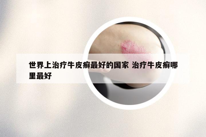 世界上治疗牛皮癣最好的国家 治疗牛皮癣哪里最好