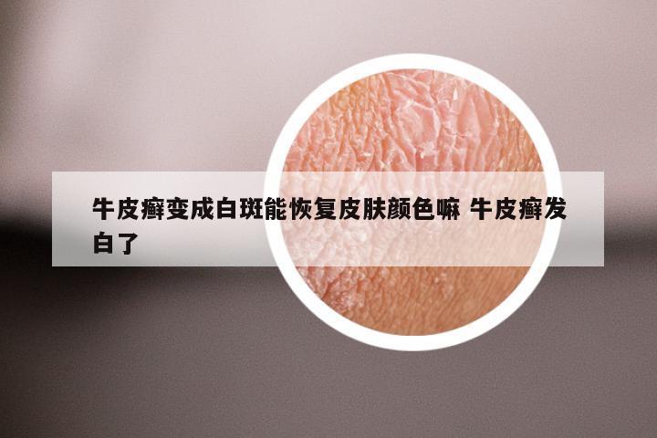 牛皮癣变成白斑能恢复皮肤颜色嘛 牛皮癣发白了