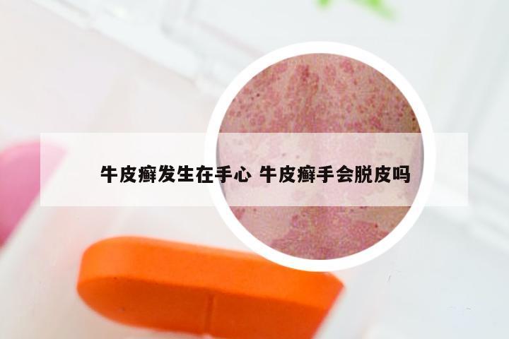 牛皮癣发生在手心 牛皮癣手会脱皮吗