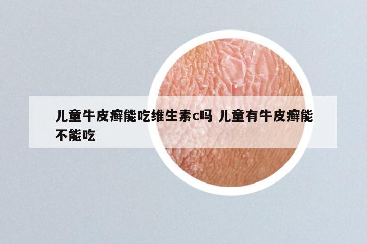 儿童牛皮癣能吃维生素c吗 儿童有牛皮癣能不能吃