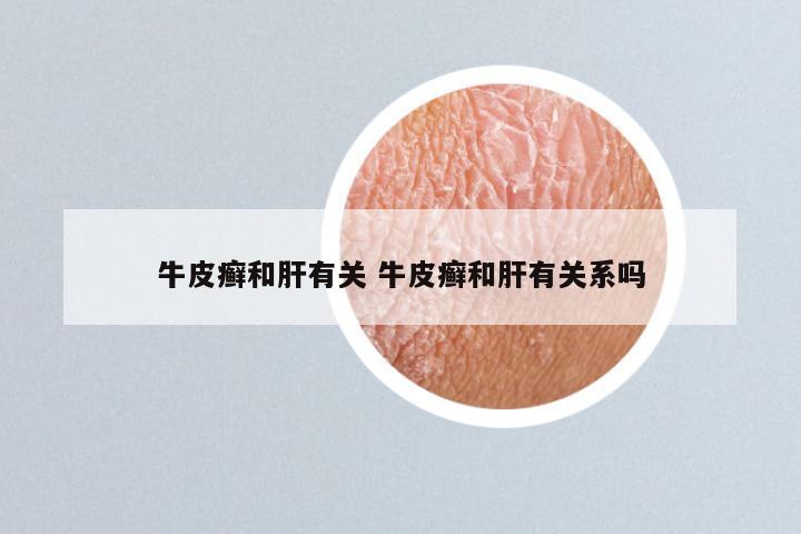 牛皮癣和肝有关 牛皮癣和肝有关系吗