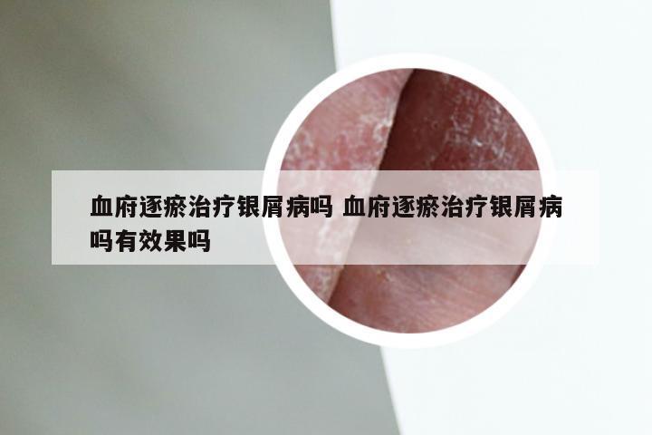 血府逐瘀治疗银屑病吗 血府逐瘀治疗银屑病吗有效果吗