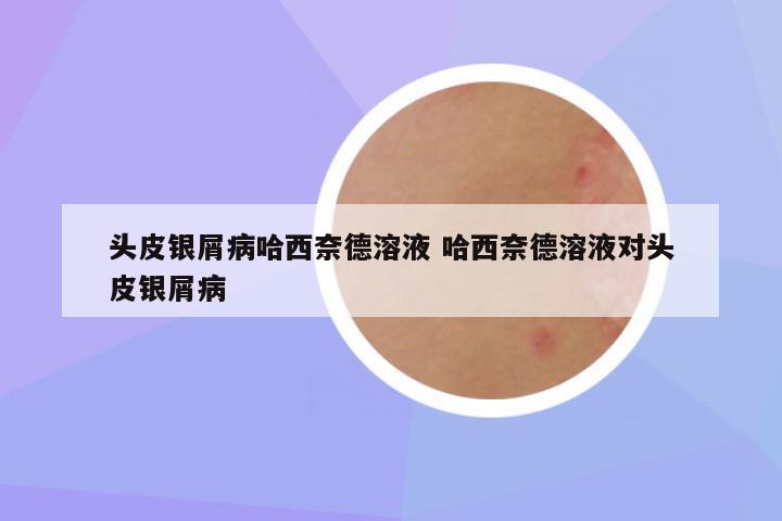 头皮银屑病哈西奈德溶液 哈西奈德溶液对头皮银屑病