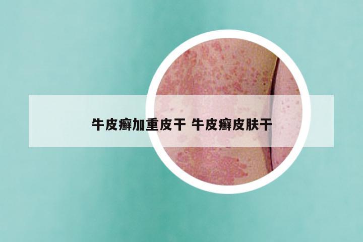 牛皮癣加重皮干 牛皮癣皮肤干