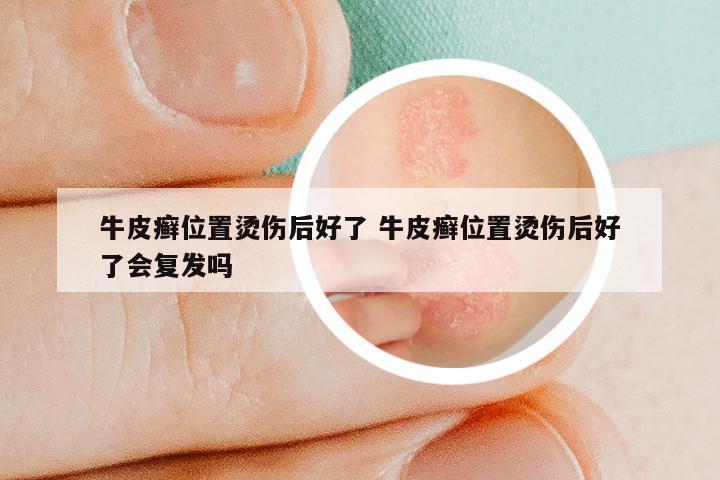 牛皮癣位置烫伤后好了 牛皮癣位置烫伤后好了会复发吗