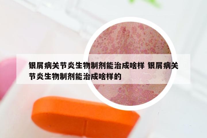 银屑病关节炎生物制剂能治成啥样 银屑病关节炎生物制剂能治成啥样的