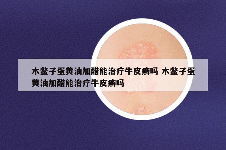 木鳖子蛋黄油加醋能治疗牛皮癣吗 木鳖子蛋黄油加醋能治疗牛皮癣吗