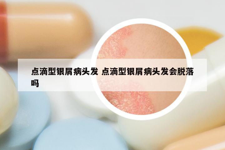 点滴型银屑病头发 点滴型银屑病头发会脱落吗