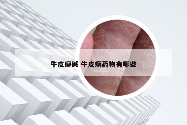 牛皮癣碱 牛皮癣药物有哪些