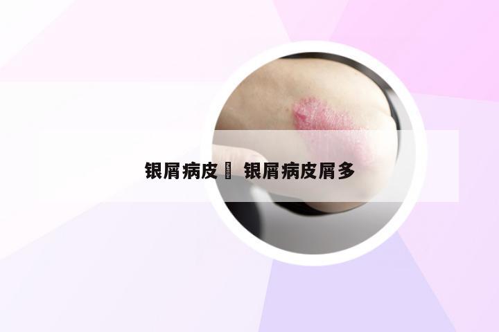 银屑病皮廯 银屑病皮屑多