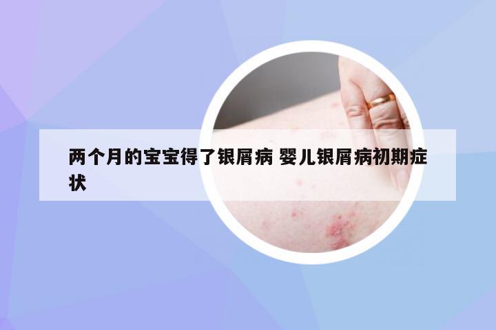 两个月的宝宝得了银屑病 婴儿银屑病初期症状