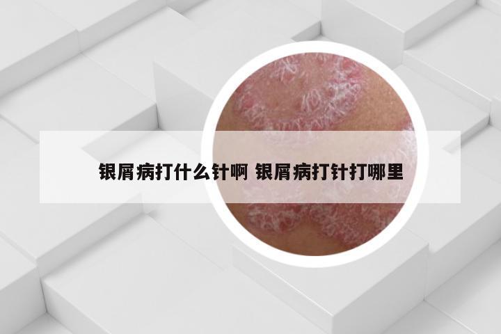 银屑病打什么针啊 银屑病打针打哪里