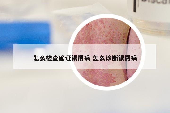 怎么检查确证银屑病 怎么诊断银屑病