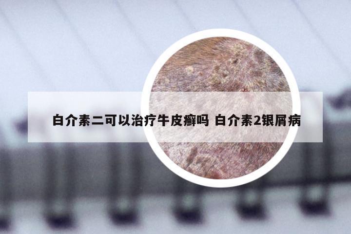 白介素二可以治疗牛皮癣吗 白介素2银屑病