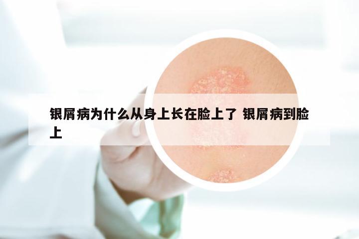 银屑病为什么从身上长在脸上了 银屑病到脸上