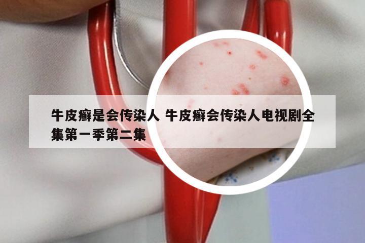 牛皮癣是会传染人 牛皮癣会传染人电视剧全集第一季第二集