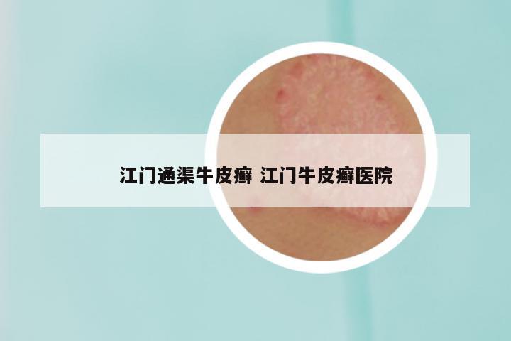 江门通渠牛皮癣 江门牛皮癣医院