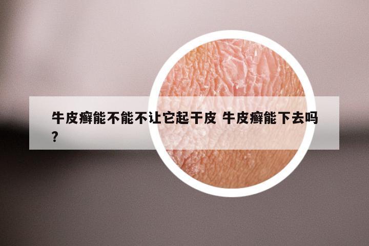 牛皮癣能不能不让它起干皮 牛皮癣能下去吗?