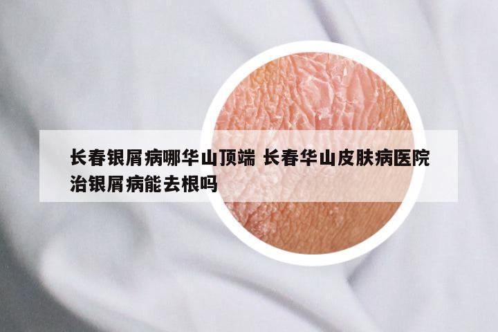 长春银屑病哪华山顶端 长春华山皮肤病医院治银屑病能去根吗