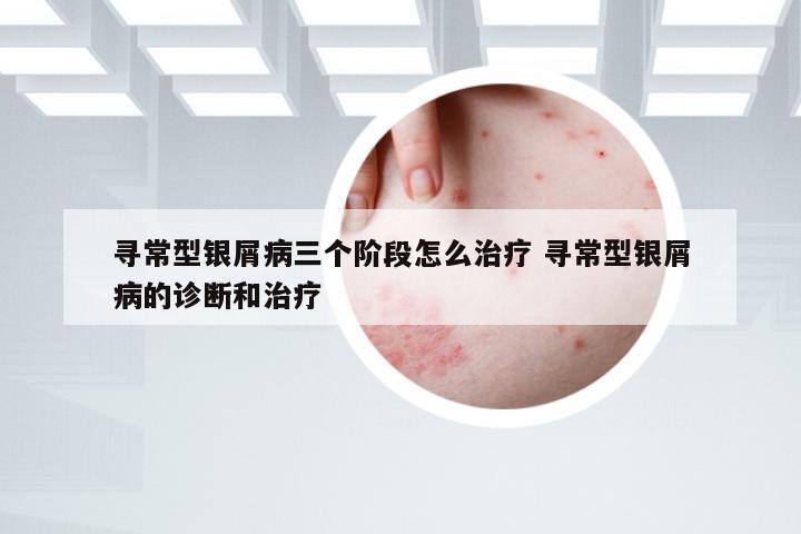 寻常型银屑病三个阶段怎么治疗 寻常型银屑病的诊断和治疗