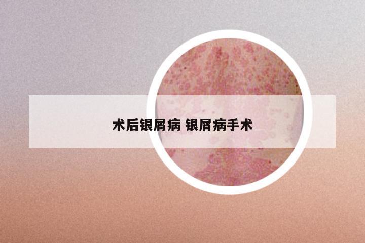 术后银屑病 银屑病手术