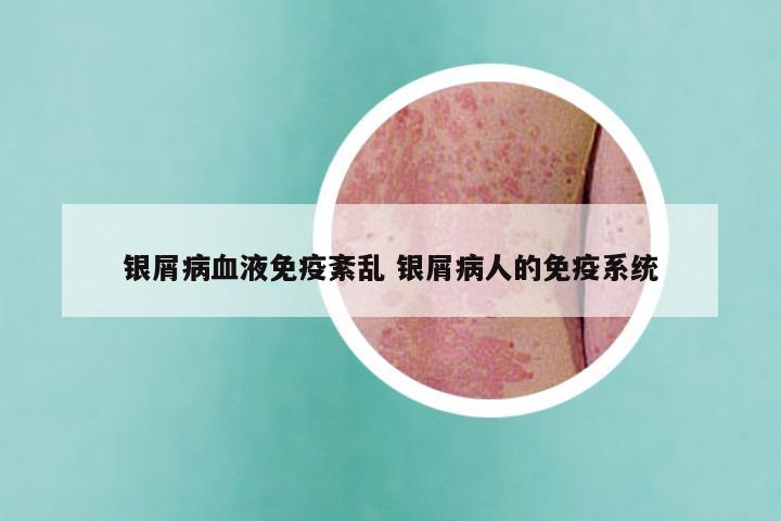银屑病血液免疫紊乱 银屑病人的免疫系统
