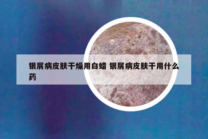 银屑病皮肤干燥用白蜡 银屑病皮肤干用什么药