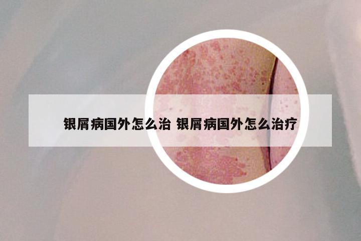 银屑病国外怎么治 银屑病国外怎么治疗
