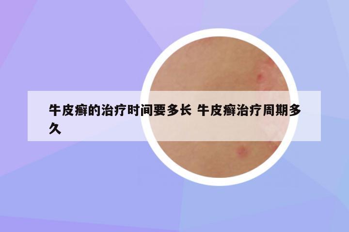牛皮癣的治疗时间要多长 牛皮癣治疗周期多久