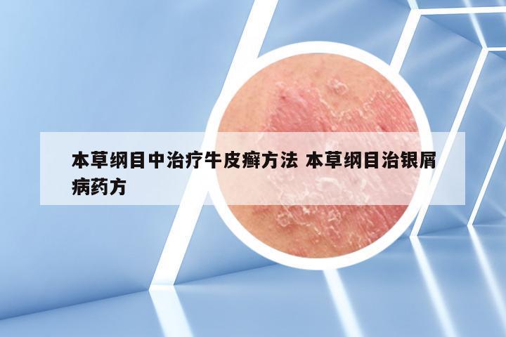 本草纲目中治疗牛皮癣方法 本草纲目治银屑病药方