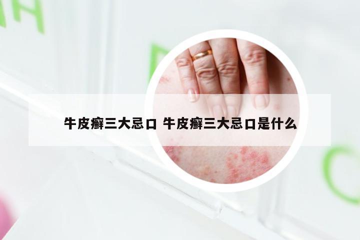 牛皮癣三大忌口 牛皮癣三大忌口是什么