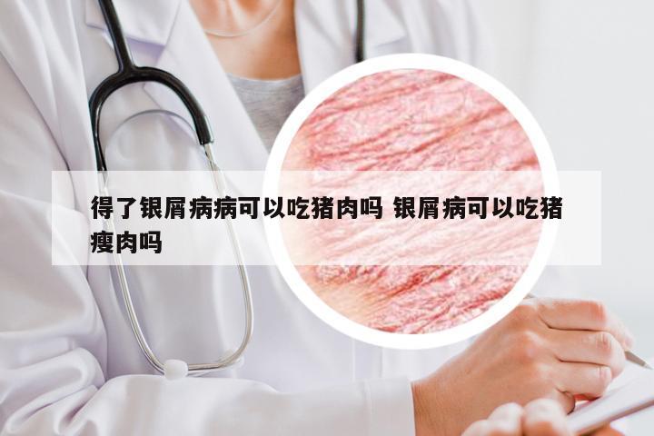 得了银屑病病可以吃猪肉吗 银屑病可以吃猪瘦肉吗