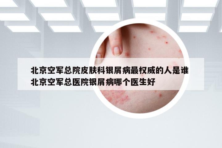 北京空军总院皮肤科银屑病最权威的人是谁 北京空军总医院银屑病哪个医生好
