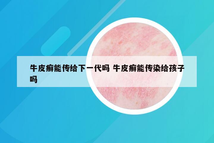 牛皮癣能传给下一代吗 牛皮癣能传染给孩子吗
