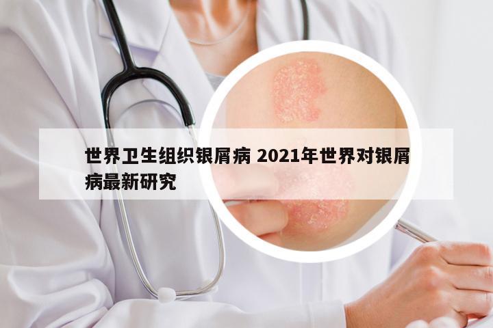 世界卫生组织银屑病 2021年世界对银屑病最新研究