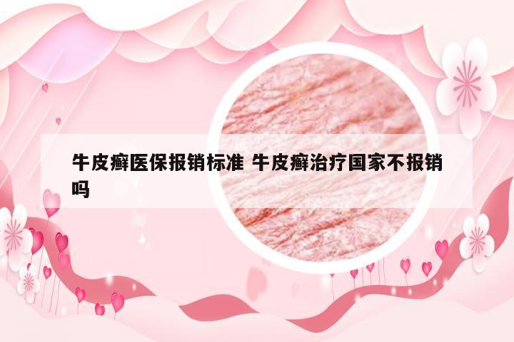 牛皮癣医保报销标准 牛皮癣治疗国家不报销吗