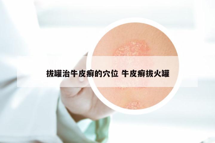 拔罐治牛皮癣的穴位 牛皮癣拔火罐