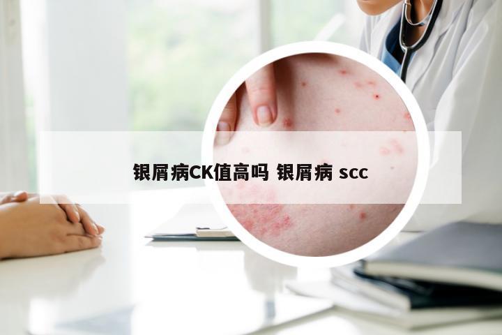银屑病CK值高吗 银屑病 scc