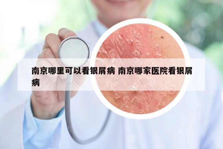 南京哪里可以看银屑病 南京哪家医院看银屑病