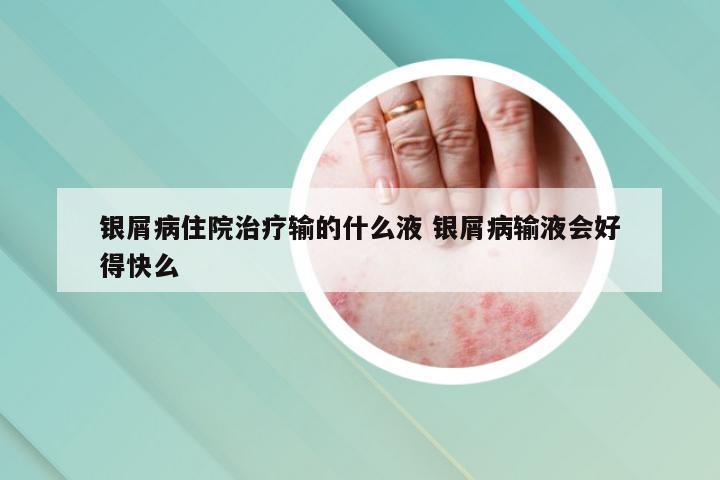 银屑病住院治疗输的什么液 银屑病输液会好得快么