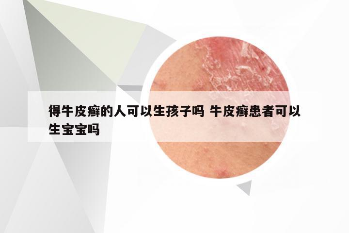 得牛皮癣的人可以生孩子吗 牛皮癣患者可以生宝宝吗