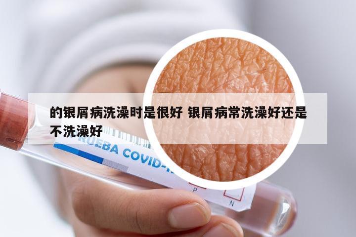 的银屑病洗澡时是很好 银屑病常洗澡好还是不洗澡好