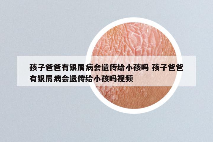 孩子爸爸有银屑病会遗传给小孩吗 孩子爸爸有银屑病会遗传给小孩吗视频