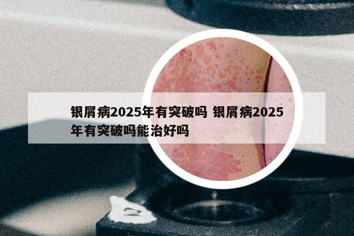 银屑病2025年有突破吗 银屑病2025年有突破吗能治好吗