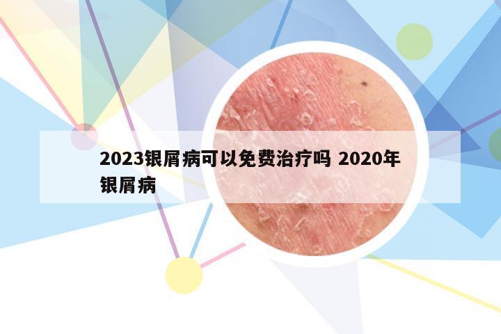 2023银屑病可以免费治疗吗 2020年银屑病