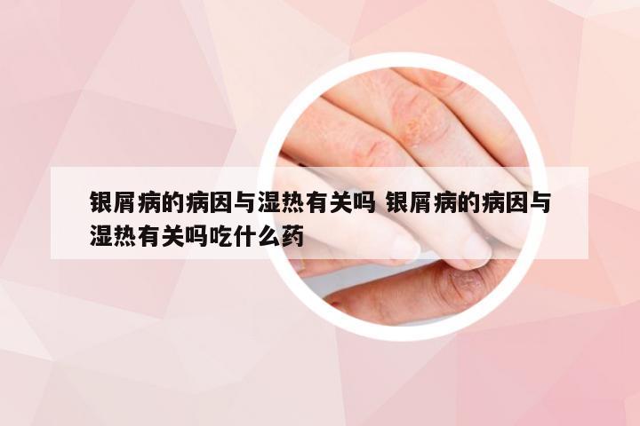 银屑病的病因与湿热有关吗 银屑病的病因与湿热有关吗吃什么药