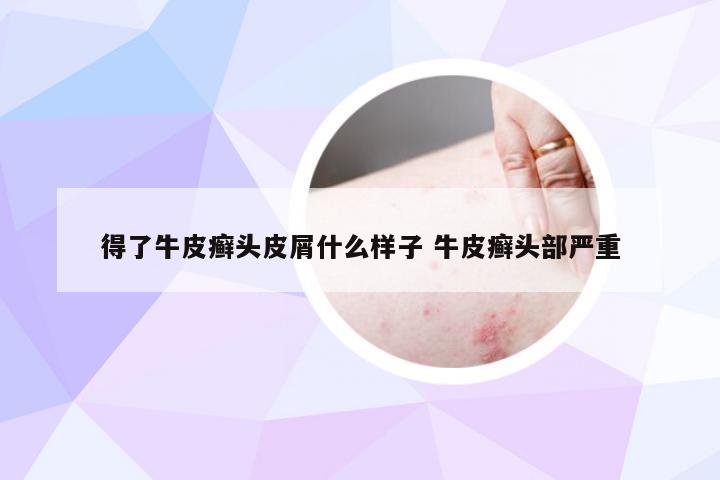 得了牛皮癣头皮屑什么样子 牛皮癣头部严重