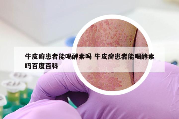 牛皮癣患者能喝酵素吗 牛皮癣患者能喝酵素吗百度百科